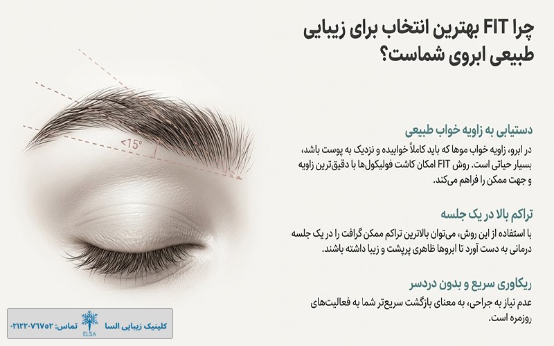 کاشت ابرو به روش FIT