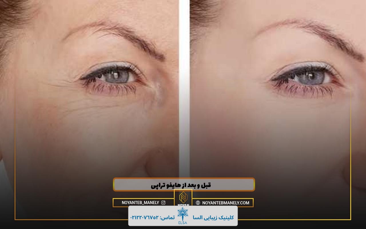 عکس های قبل و بعد از هایفو