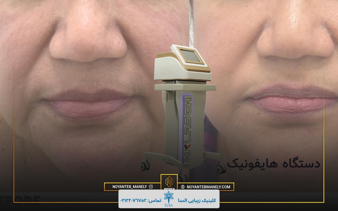 بهترین دستگاه هایفو در ایران