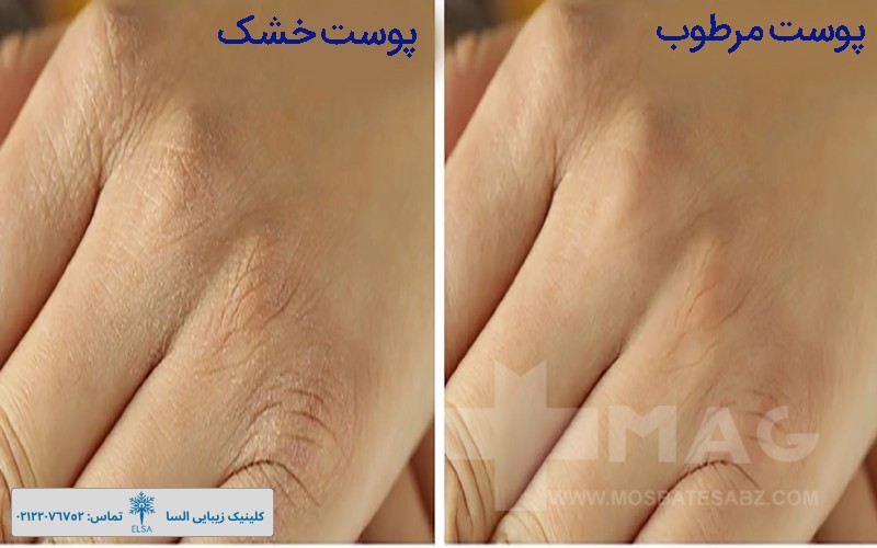 تفاوت پوست خشک و مرطوب