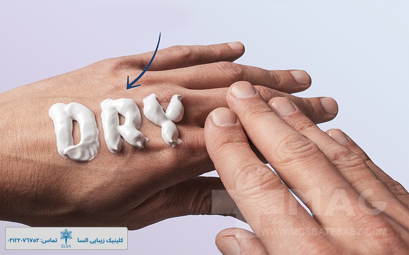کرم برای پوست خشک دست