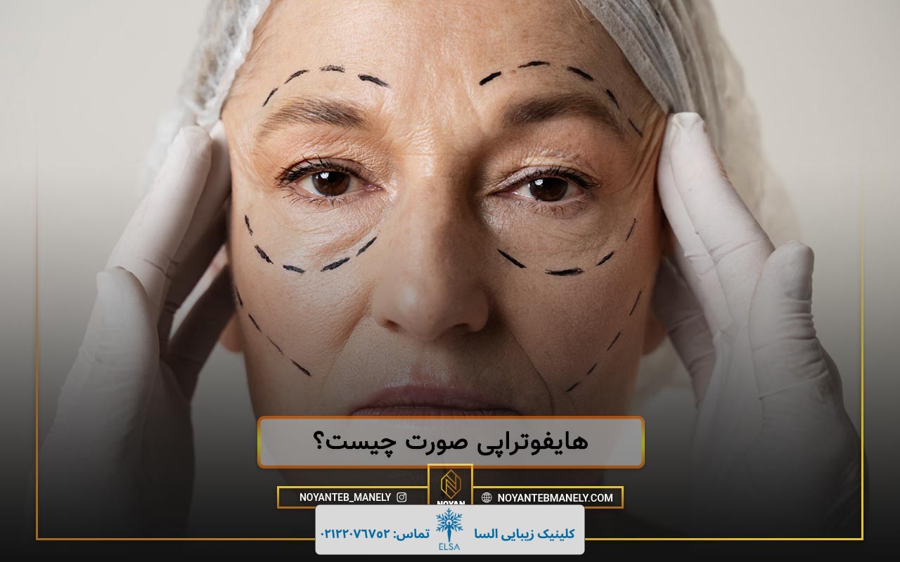 تاثیر هایفو بر صورت