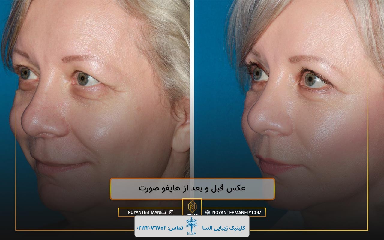 قبل و بعد از هایفو صورت