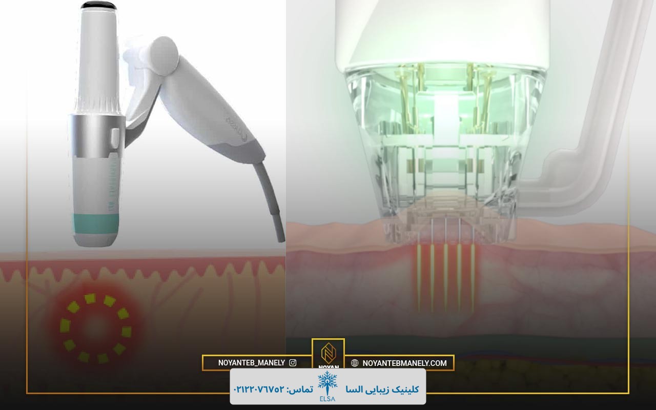 مزایای جدید دستگاه هایفو 12 بعدی