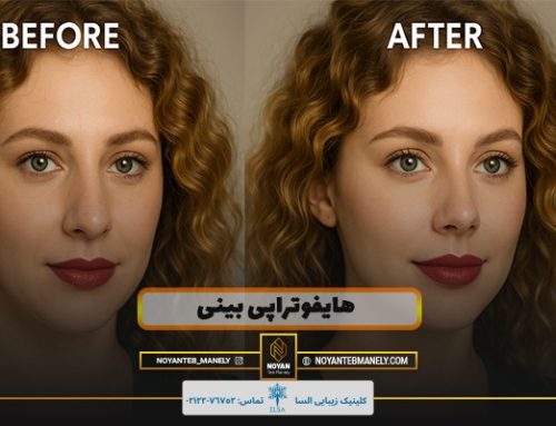 هایفوتراپی بینی برای چه بینی های مناسب است؟