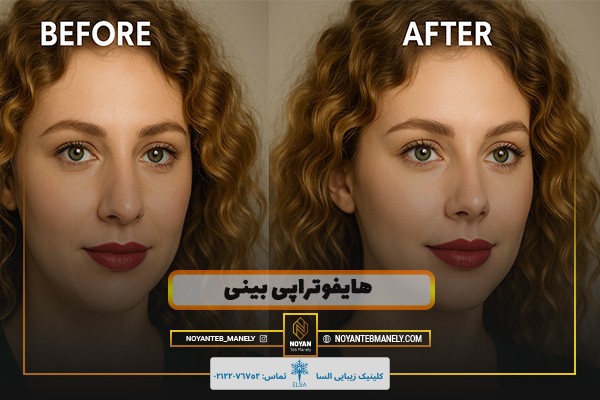 قبل و بعد از هایفو بینی