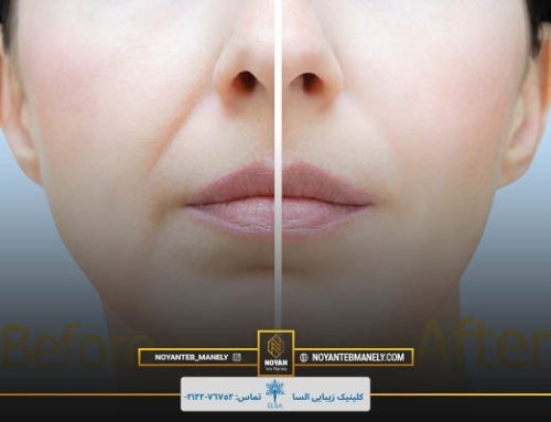 ماندگاری هایفوتراپی خط لبخند