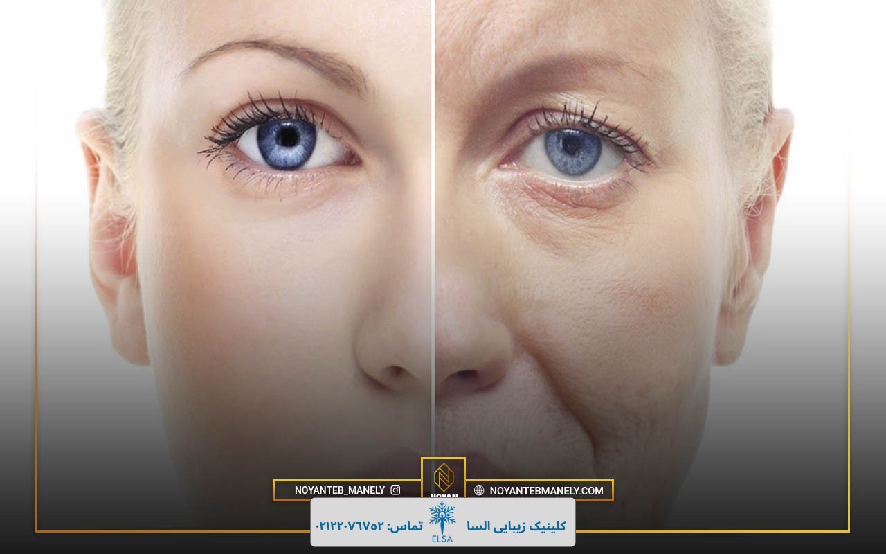 از بین بردن خط خنده با هایفوتراپی