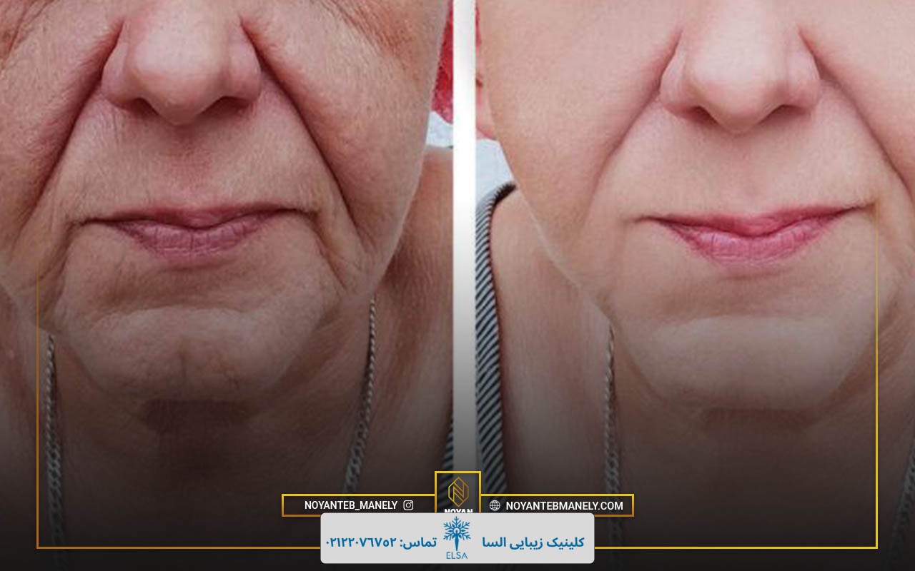 رفع خط لبخند با هایفوتراپی