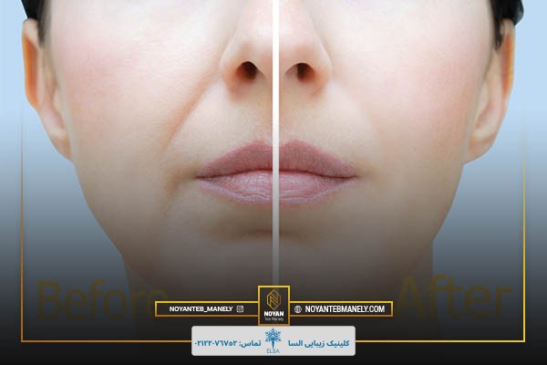 هایفوتراپی خط لبخند