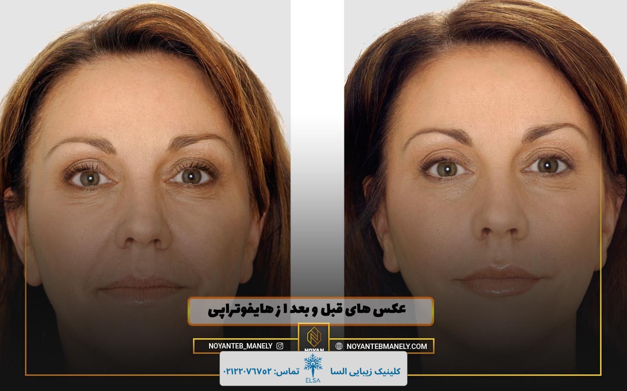 من هایفو انجام دادم نی نی سایت