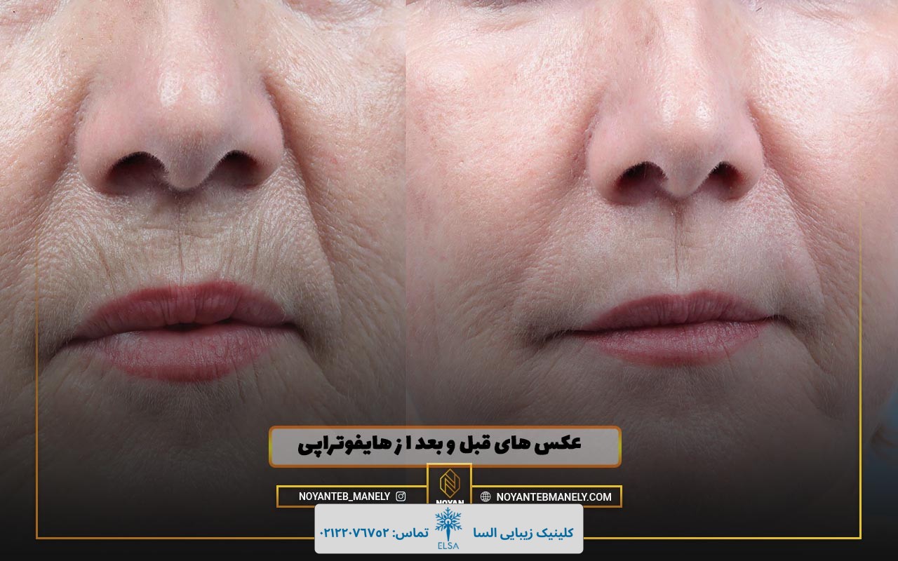 من هایفو انجام دادم نی نی سایت