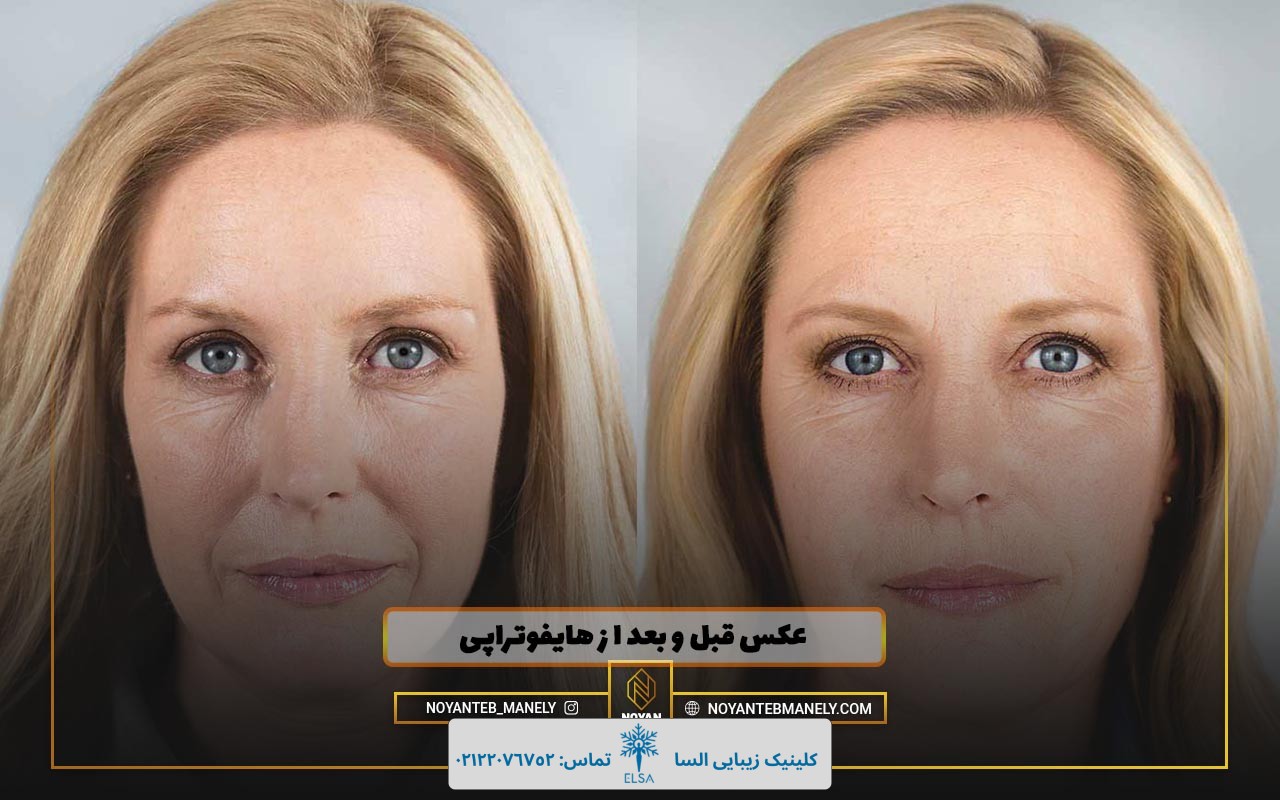 نظرات کسانی که هایفوتراپی انجام داده اند نی نی سایت