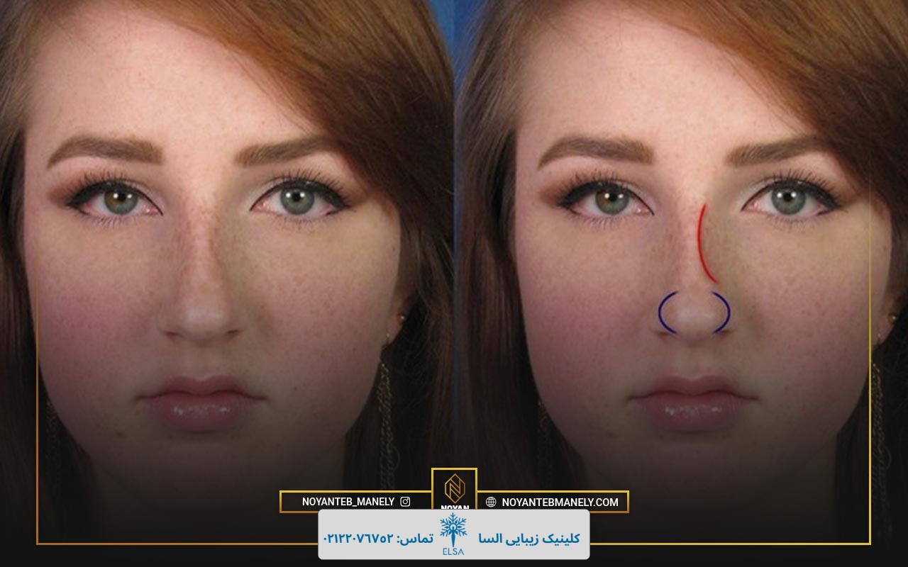 ماندگاهری هایفوتراپی بینی