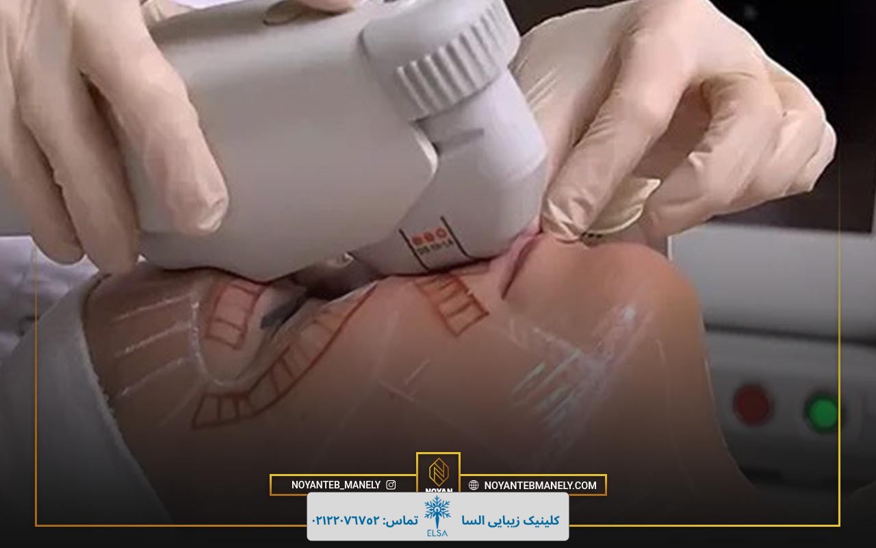 سن مناسب برای هایفو