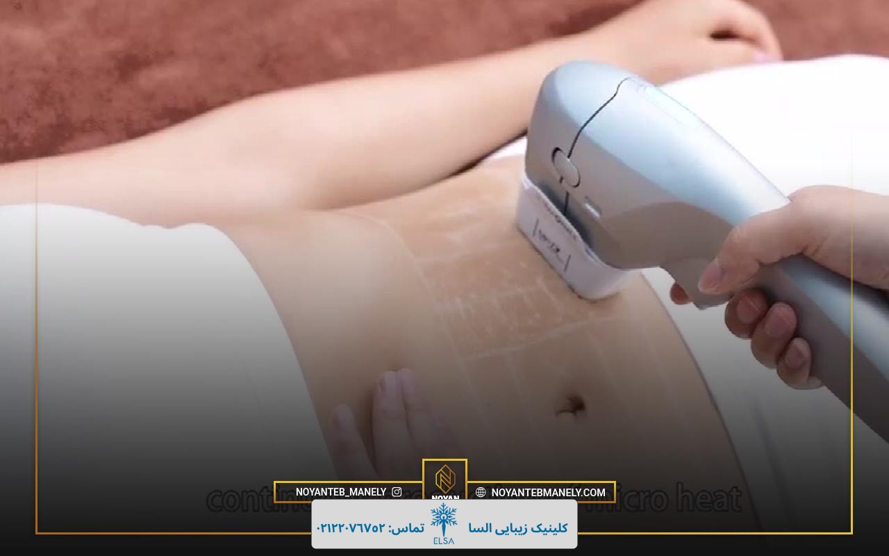 سن مناسب انجام هایفو چند است؟