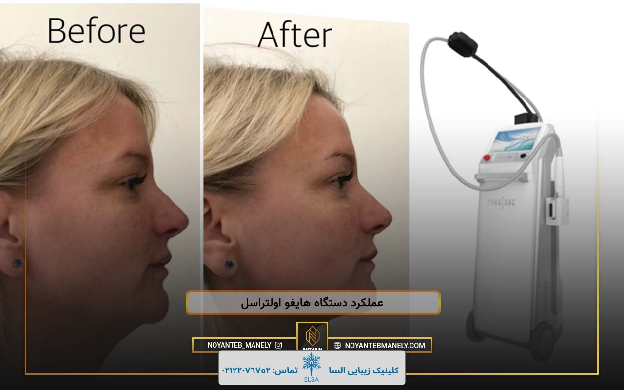 هایفو اولتراسل