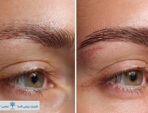 کاشت ابروی دائمی با متد FIT؛ چگونه طبیعی‌ترین خواب ابرو را تضمین کنیم؟