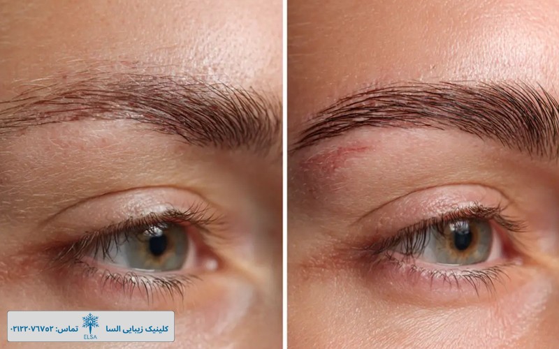 کاشت ابرو در کلینیک ونوس ظفر